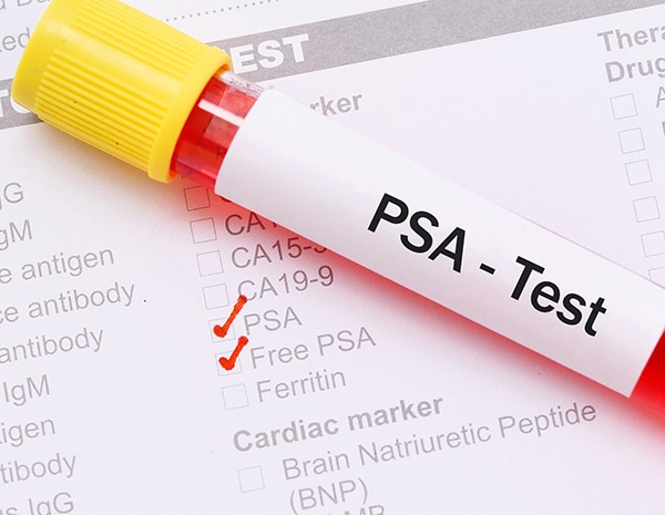 Revised Prostate Cancer Screening Guidelines Proposed | Cancer Today