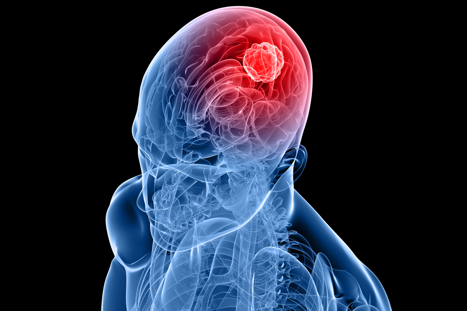 A New Treatment for Some Brain Tumors